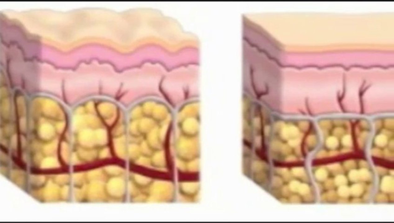 Celulitis nunca mas http://xurl.es/sin-celulitis 
