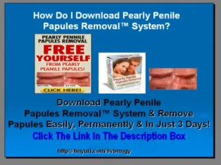 Pearly Penile Papules Removal Review - DO NOT BUY This Product Until You Watch This Video!