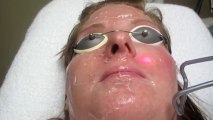 Rosacea Treatment With Laser-Anaheim-Brea-Fullerton-Yorba Linda-Chino Hills-Corona