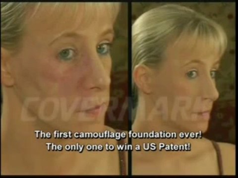 Covermark Cover Cream covers tattoos, rosacea, birthmarks, scars, and more