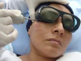 Tratamiento Rosacea, tratamiento láser para Rosacea, eliminar rosacea en Lima Perú