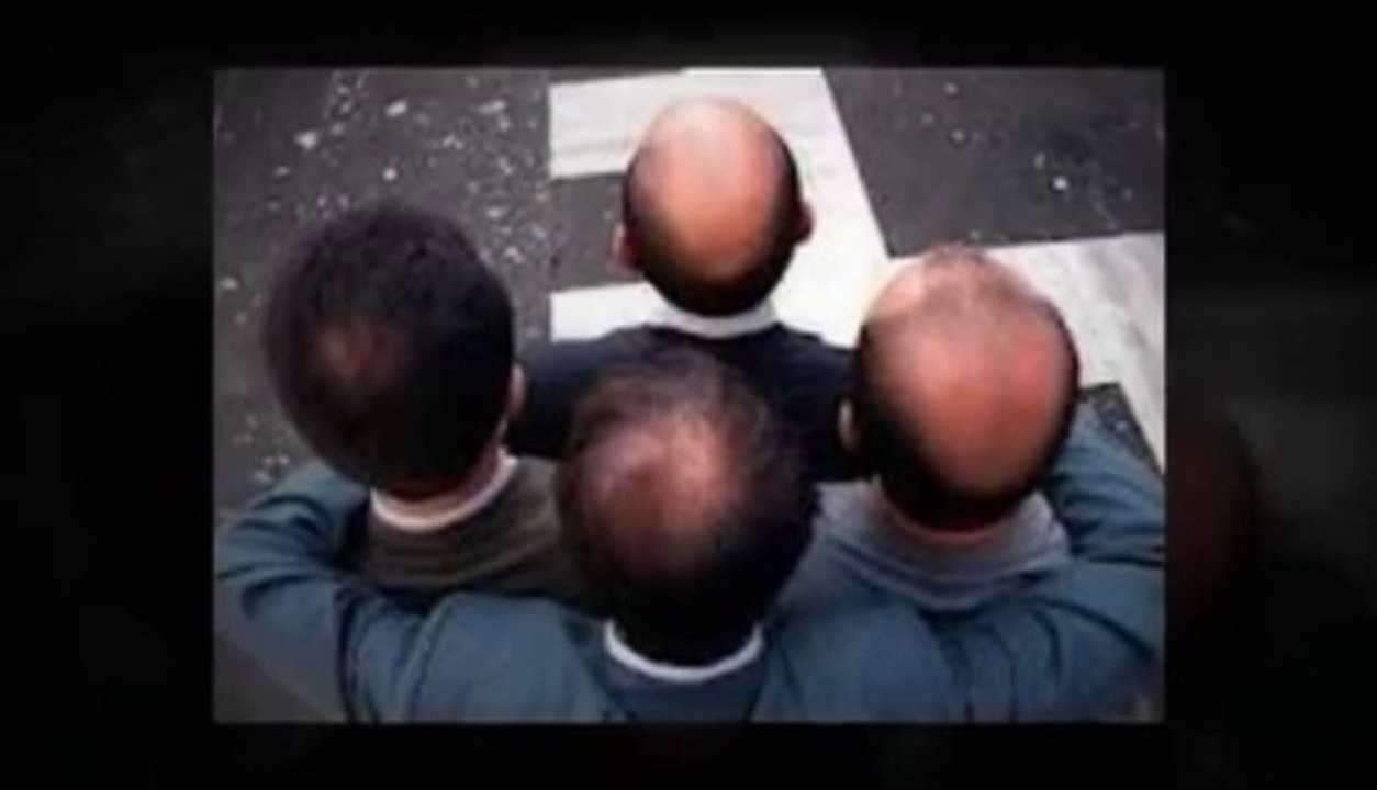 Hair Loss Blueprint Review! Review On Hair Loss Baldness Treatment Blueprint