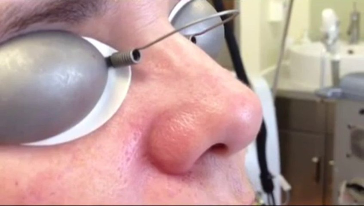 Rosacea and laser treatment for rosacea