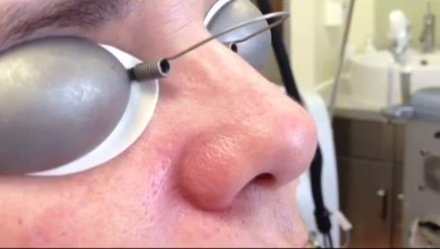 Rosacea and laser treatment for rosacea