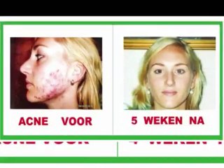New, Unique!!! Impressive results. Acne/Rosacea disappears in 2 weeks by "Rositta" Method.