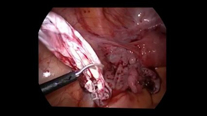 Laparoskopi ile Over kist eksizyonu - Prof. Dr. Aydan Biri