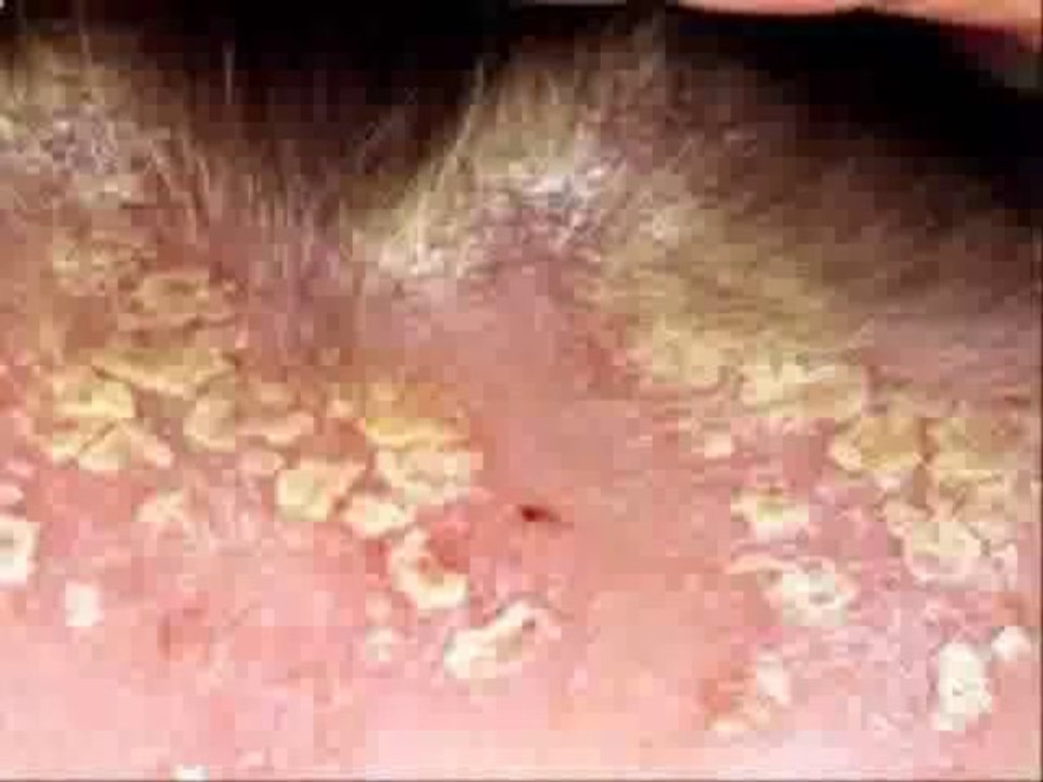 Moroccanoil Dry No More Scalp Treatment Instructions No More Dry Scalp Ebook Reviews