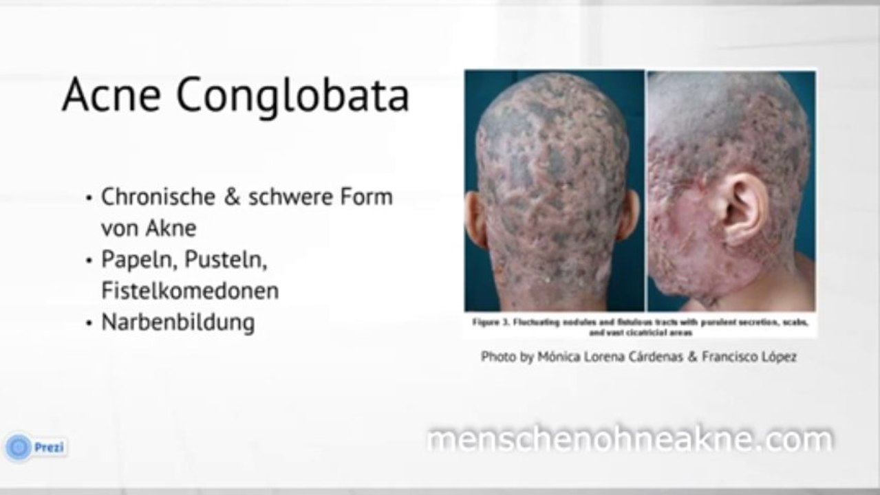 Akneformen [Teil 1] - Akne Vulgaris, Akne Rosacea, Acne Conglobata usw.