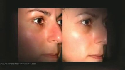 Banish Rosacea Review