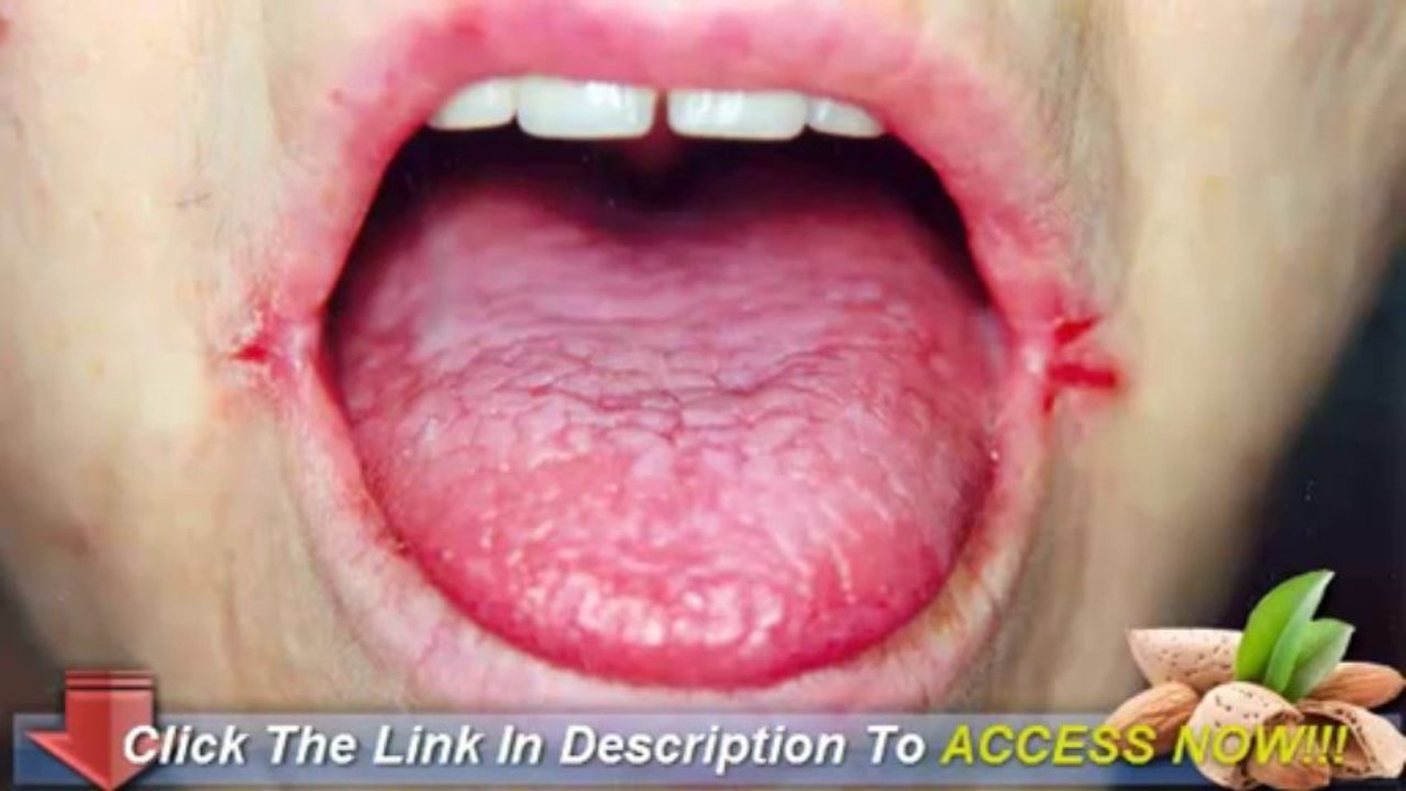 Angular Cheilitis Overnight Cure - Want An Overnight Cure For Angular Cheilitis?