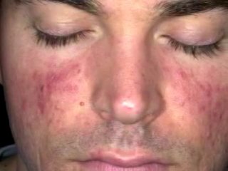 Acne Rosacea Papulopustular