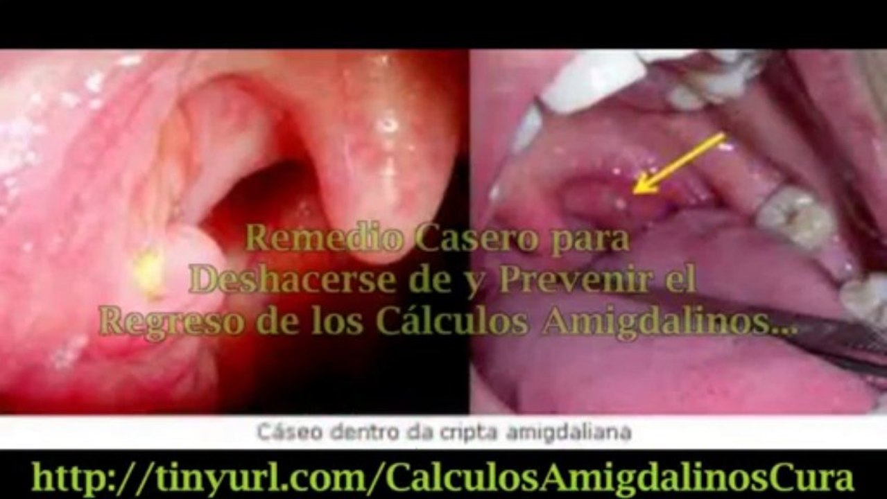 Pelotitas Blancas En Las Amigdalas Olorosas - Tratamiento Natural A Los Calculos Amigdalinos 