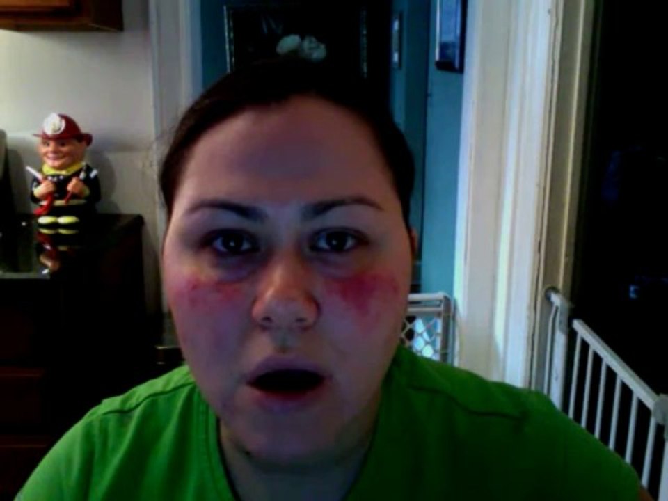 Living with rosacea