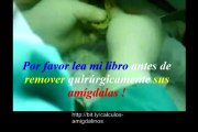Remedios Caseros Para La Garganta - Calculos Amigdalinos