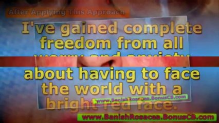 natural rosacea treatment - how to get rid of rosacea - natural treatment for rosacea