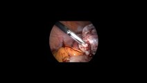 Laparoskopi ile Ovarial kitle eksizyonu 2 - Prof. Dr. Aydan Biri