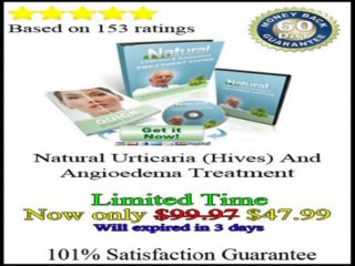 Get Rid Of Hives Review + Discount +++ 100% Real and Honest +++