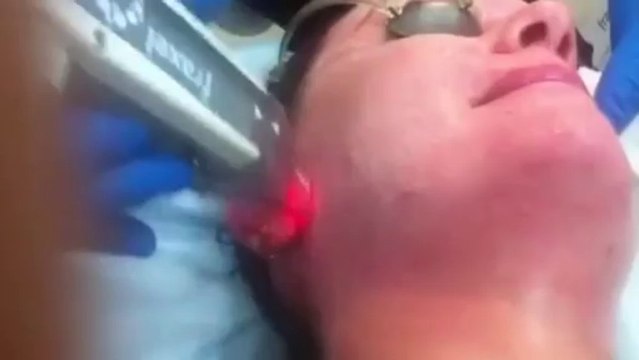 Sydney Fraxel Restore Repair lasers pigment, scars, rosacea, sun damage treatments Sydney