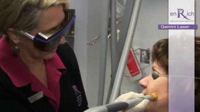 Spider veins, rosacea and vascular treatments with Gemini Laser @ enRich | Melbourne