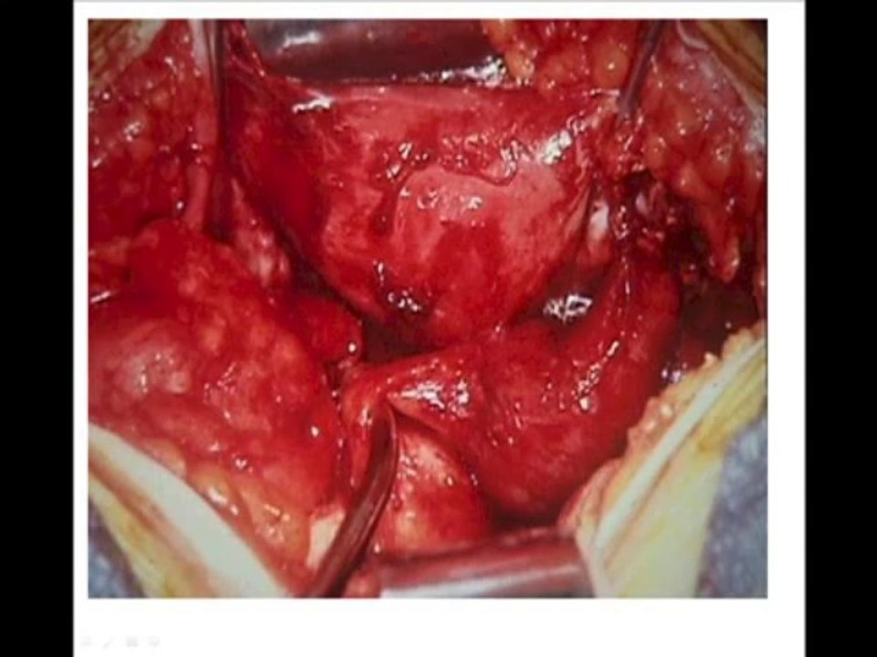 Como Quedar Embarazada en 60 Dias aun con Endometriosis