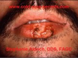 Herpes Book-Get Rid of Cold Sores Fast!