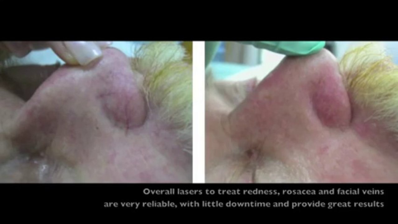 Lasers for Redness, Rosacea & Veins | Dermatologist Brandith Irwin M.D. Skintour.com