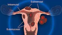 Como Curar los Fibromas Naturalmente - Curar fibromas - Fibromas en el utero