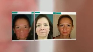 Rosacea Cura - Remedio Natural Para Curar La Rosácea