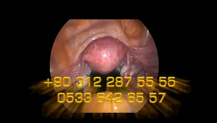 Diagnostik laparoskopi, diagnostik Histeroskopi 2 - Prof. Dr. Aydan Biri