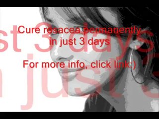 How to Cure Rosacea at Home - Find Out How to Get Relief From the Inflammation Without Medication