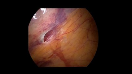 Diagnostik laparoskopi  - Prof. Dr. Aydan Biri