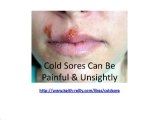 Best Cold Sore Treatment - How To Get Rid Of Cold Sores Fast