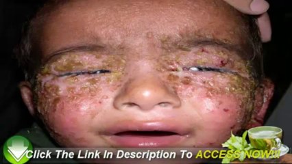 How To Cure Impetigo - Just Beat it