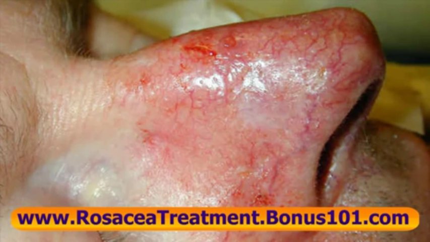 rosacea treatments – treatments for rosacea – papulopustular rosacea