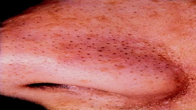 How to get rid of acne overnight- Overnight Acne cure