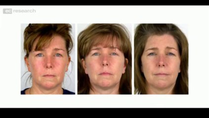 ProPLEXIN® System 2 For Rosacea Commercial