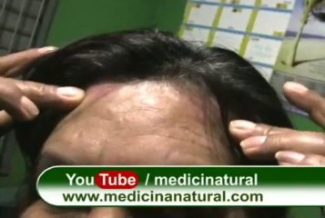 acne rosacea remedio casero plantas medicinales uriel tapia