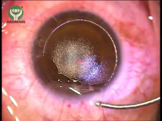 FEMTO Second Laser for Getting Rid of Glasses