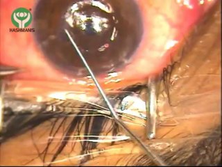 INTACS Implantation for Keratoconus