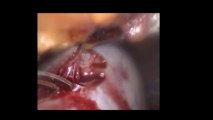 Laparoskopi ile Ovarial kist eksizyonu 2 - Prof. Dr. Aydan Biri