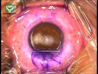 Keratom Flap Laser (LASIK Laser for Rid of Glasses)