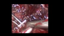 Laparoskopi ile Ovarial kist eksizyonu 32 - Prof. Dr. Aydan Biri