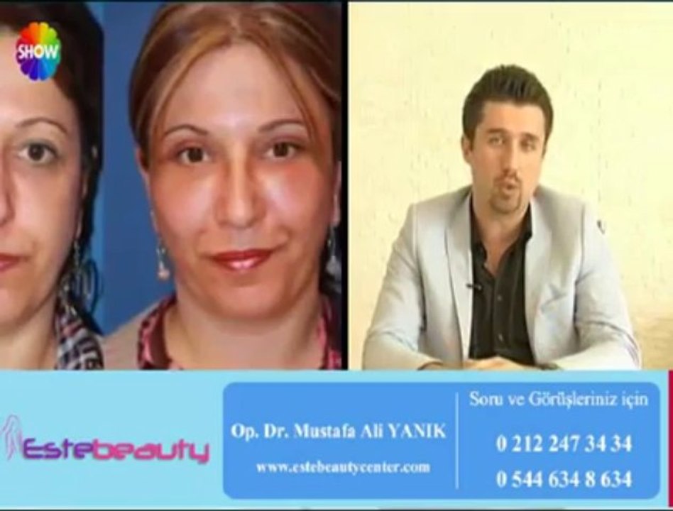 Alın Germe Dolgu ve Botoks Uygulamaları