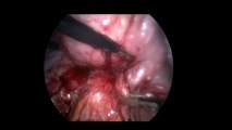 Laparoskopi ile Endometirozis 3 - Prof. Dr. Aydan Biri