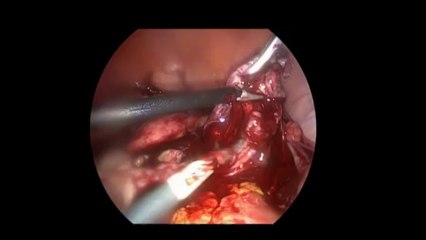 Laparoskopi ile Over Kist eksizyonu 3  - Prof. Dr. Aydan Biri