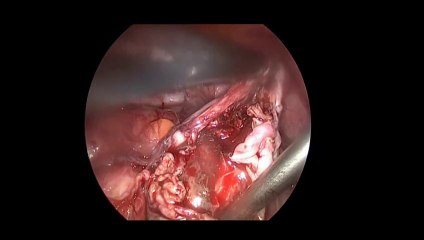 Laparoskopi ile Over Kist eksizyonu 8  - Prof. Dr. Aydan Biri