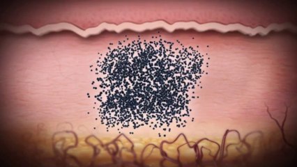 Best Tattoo Removal Service in Charlotte NC 704-344-8846
