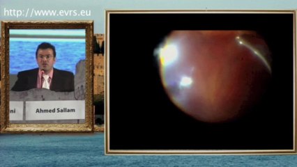 Retinal Detachment Surgery Tips:tricks Ahmed Sallam