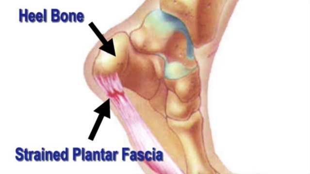 Heel Pain - Podiatrist in Uvalde, TX and San Antonio, TX - Steven Snider, DPM