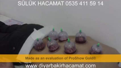 SÜLÜK HACAMAT TEDAVİ  DİYARBAKIR  0535 411 59 14